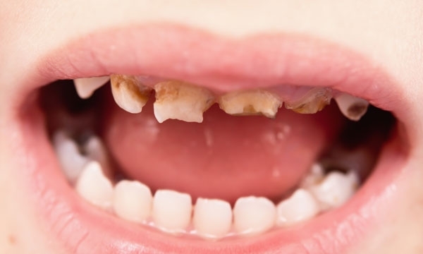 Những căn bệnh ‘kinh khủng’ của miệng, bạn biết gì về chúng?